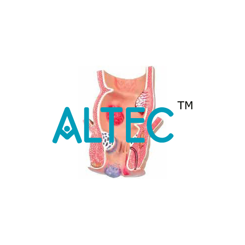 Pathological Model Of The Rectum