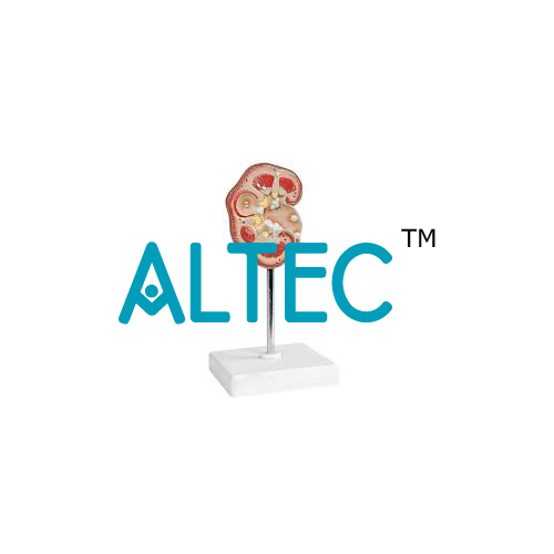Pathological Model Of Renal Calculus
